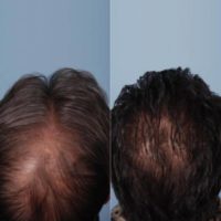 35-44 year old man treated with PRP for Hair Loss