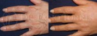45-54 year old woman treated with Hand Rejuvenation