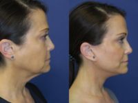 47 year old woman treated with facelift, upper and lower blepharoplasties, and fat grafts to face
