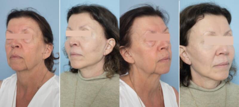 55-64 year old woman treated with Deep Plane Facelift, Facelift, Eyelid Surgery, Neck Lift, SMAS Facelift