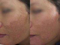 59 year old woman treated with profractional laser for melasma