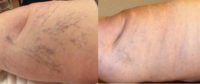 68 year old woman treated with sclerotherapy for her veins