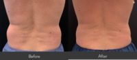 55-64 year old man treated with CoolSculpting Elite