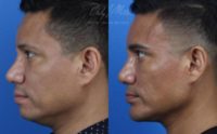 35-44 year old man treated with Chin Implant