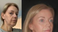 50 year old woman treated with TBT Facelift