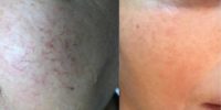 Laser Capillary Removal at Skintology