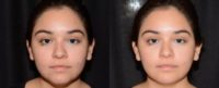 18-24 year old woman treated with Chin Fillers