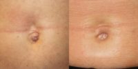 25-34 year old woman treated with Belly Button Surgery