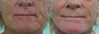 55-64 year old woman treated with Dermabrasion