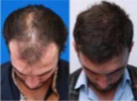 35-44 year old man treated with Organic Hair Transplant