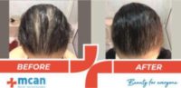 25-34 year old woman treated with Hair Loss Treatment