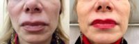 45-54 year old woman treated with Facial Fat Transfer