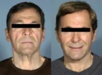 55-64 year old man treated with Facelift