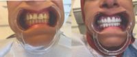 Woman treated with Dental Crown
