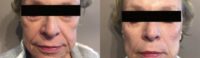 65-74 year old woman treated with Non Surgical Face Lift