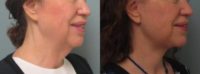 65-74 year old woman treated with Neck Lift