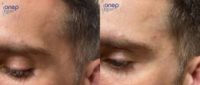 35-44 year old man treated with Facelift, Dermal Fillers