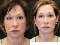 55-64 year old woman treated with Facelift