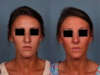 18-24 year old woman treated with Rhinoplasty