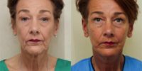 Patient in mid 50s treated with Lower Facelift